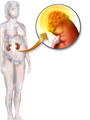 Hypercortisolism