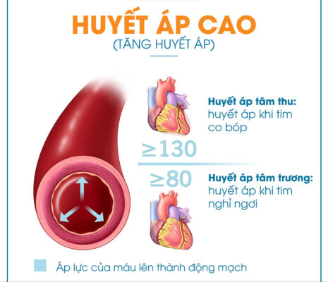 Huyết áp cao