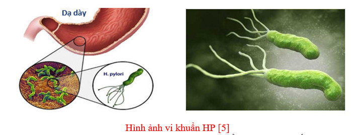 Vi khuẩn Helicobacter pylori và loét có thể gây xuất huyết dạ dày