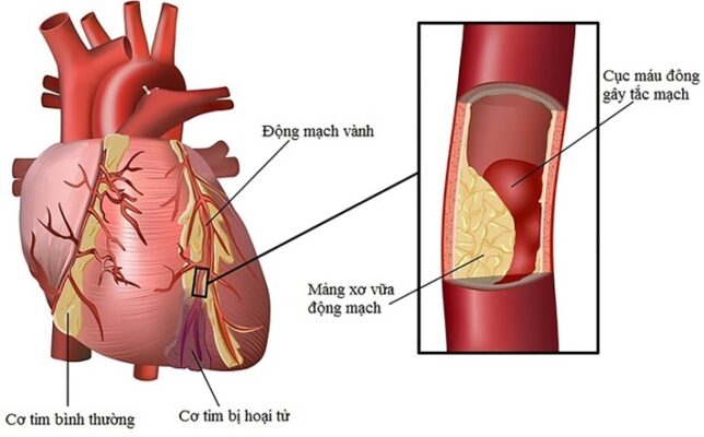 Bệnh mạch vành do mảng xơ vữa làm hẹp động mạch vành