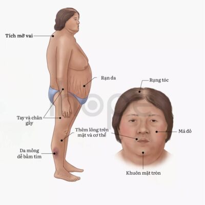 biểu hiện hội chứng Cusing