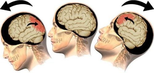 chấn thương sọ não là gì và tổn thương não