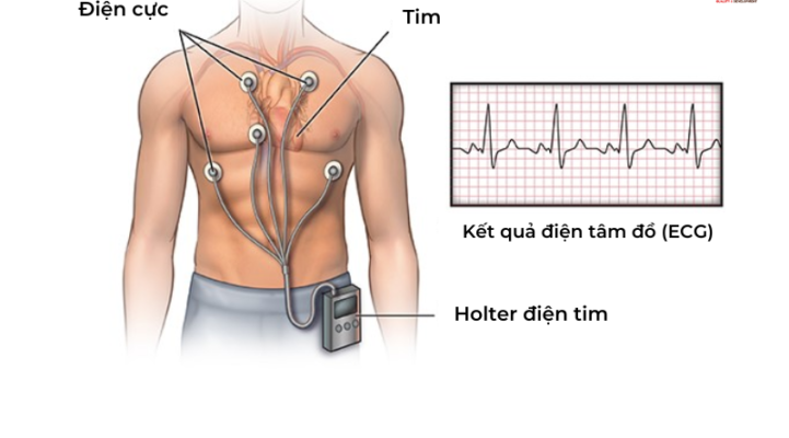 đặt điện cực ECG giúp chẩn đoán nhịp chậm xoang
