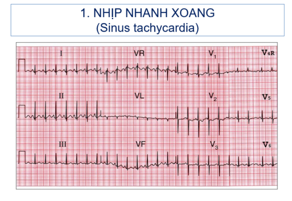 điện tâm đồ cho thấy nhịp tim không đều theo chu kỳ hô hấp