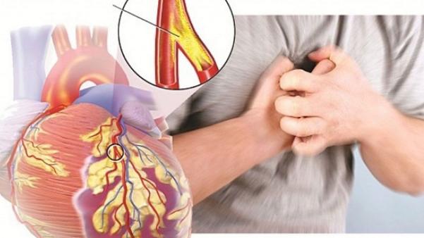 Dấu hiệu bệnh mạch vành đau thắt ngực lan ra vai tay hàm