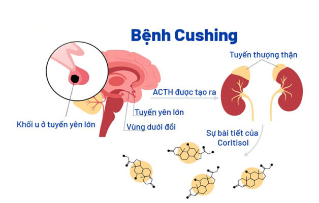 hội chứng cushing