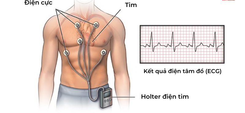 Theo dõi Holter hỗ trợ chẩn đoán nhịp nhanh xoang