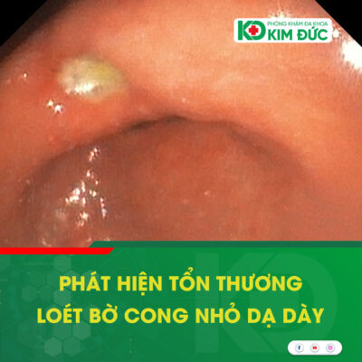 loét bờ cong nhỏ dạ dày