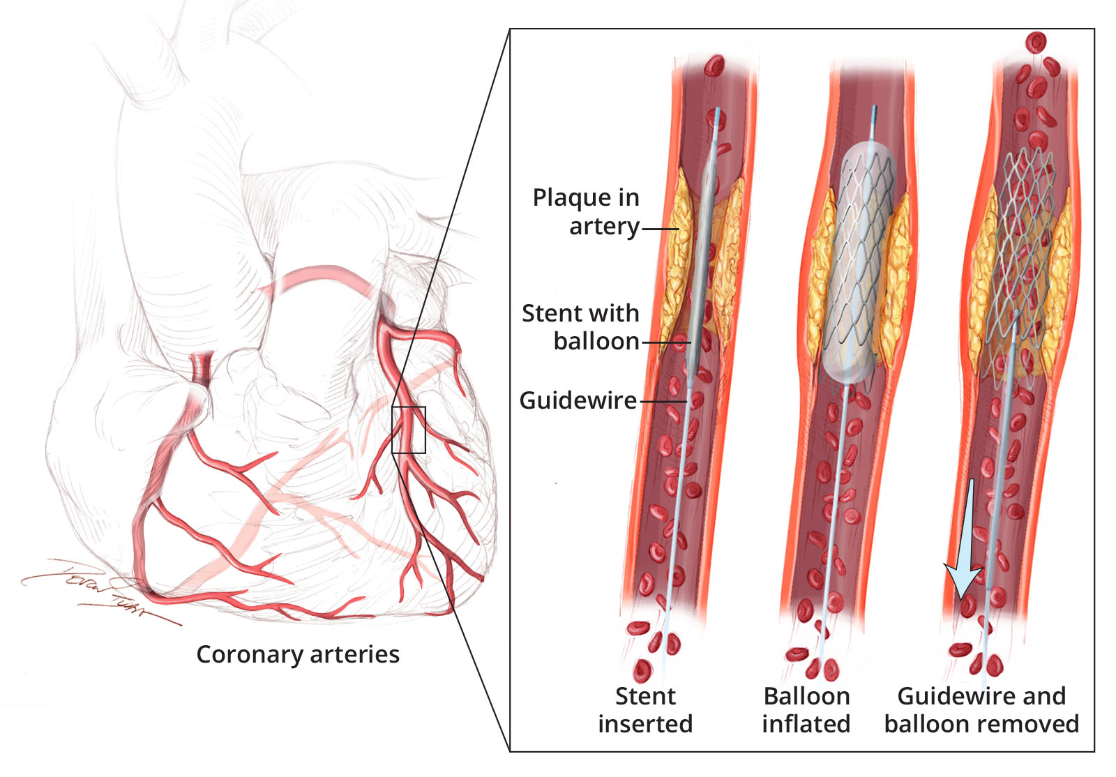 Điều trị bệnh mạch vành bằng đặt stent động mạch vành