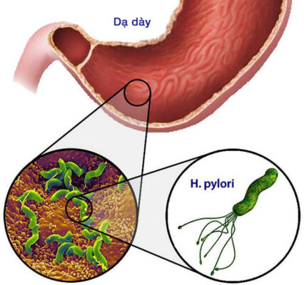 Vi khuẩn Helicobacter pylori gây viêm niêm mạ
