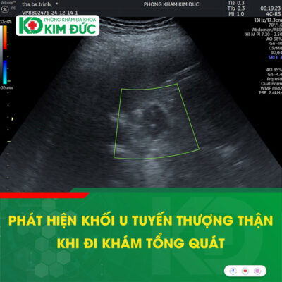 u tuyến thượng thận