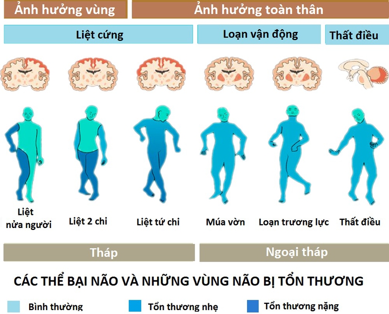 bại não ở trẻ em dấu hiệu bại não sớm qua chậm ngẩng đầu chậm lẫy