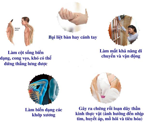 Đau lan xuống cánh tay kèm tê tay do chèn ép thần kinh cổ
