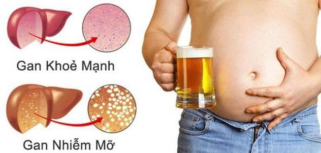 nguyên nhân gan nhiễm mỡ do bia rượu