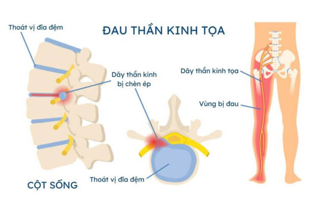 Hình minh họa đau thần kinh tọa với kiểu đau lan chân, một dấu hiệu cần được đánh giá đúng nguyên nhân.