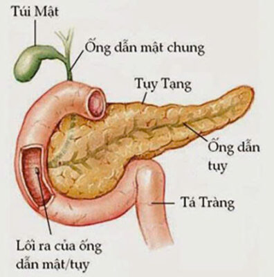 Viêm tụy cấp là gì