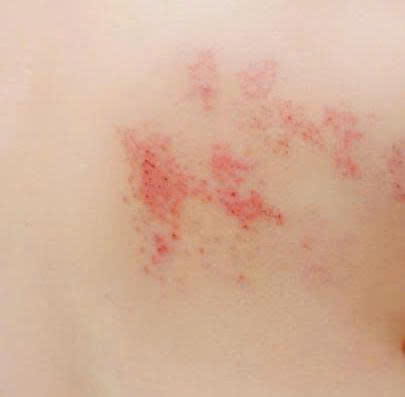 zona thần kinh là gì biểu hiện mụn nước