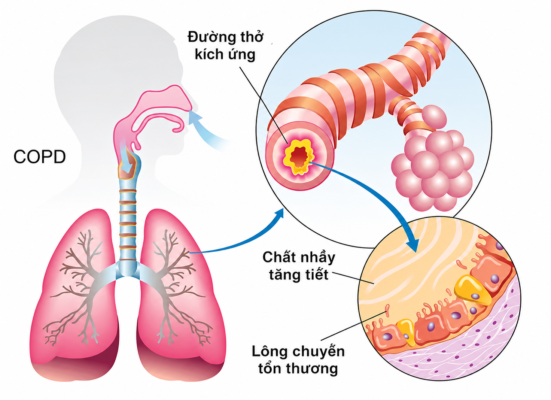 Nguyên nhân bệnh phổi do hút thuốc và tắt nghẽn COPD