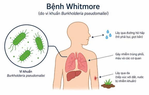 Người mắc bệnh Whitmore có thể sốt cao, viêm phổi, áp xe và nhiễm trùng da.