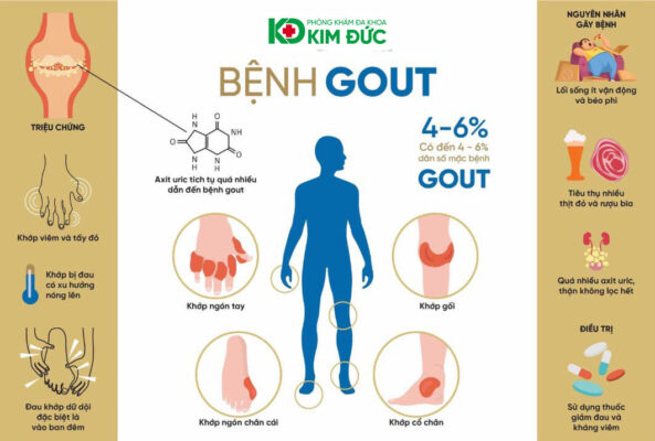 triệu chứng bệnh gout ở bàn chân và ngón chân cái