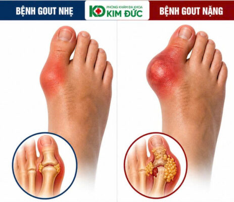 dấu hiệu gout nhẹ và dấu hiệu gout nặng ở khớp ngón chân
