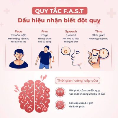 Dấu hiệu đột quỵ theo quy tắc FAST