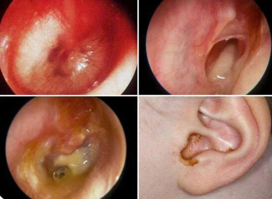 Màng nhĩ bị thủng có thể tự lành nếu lỗ thủng nhỏ và không nhiễm trùng