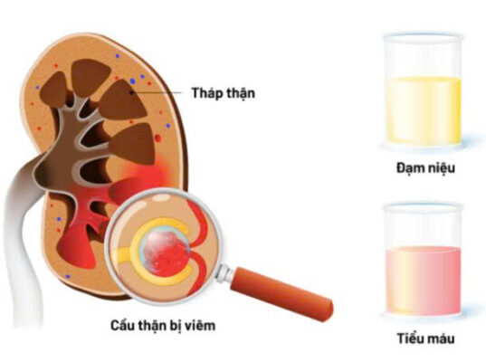 Xét nghiệm nước tiểu giúp chẩn đoán viêm cầu thận cấp