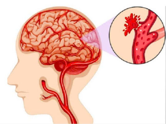 Dấu hiệu cảnh báo tai biến mạch máu não cần cấp cứu