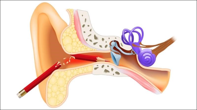 không ngoáy tai sâu khi bị thủng màng nhĩ