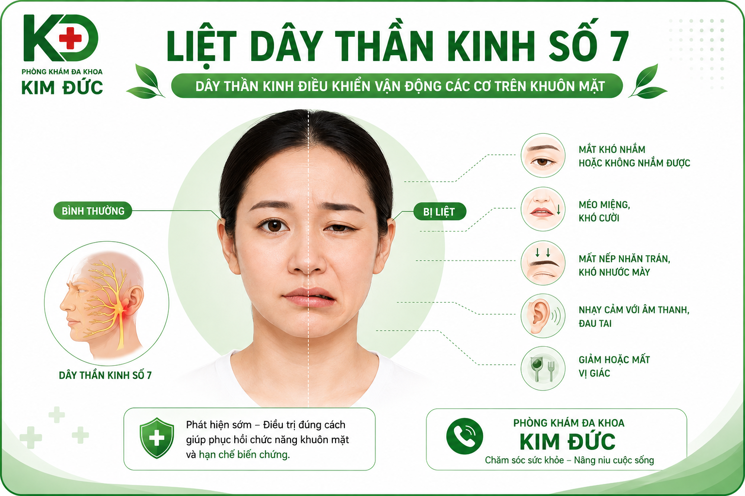 Liệt dây thần kinh số 7