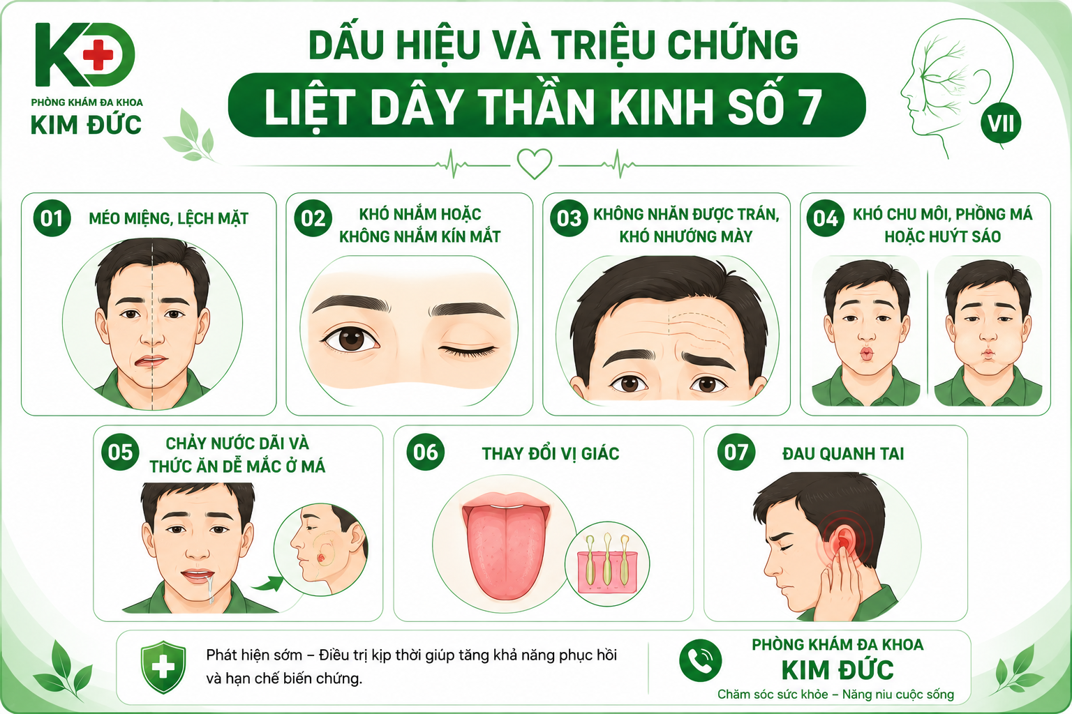 Dấu hiệu và triệu chứng liệt dây thần kinh số 7